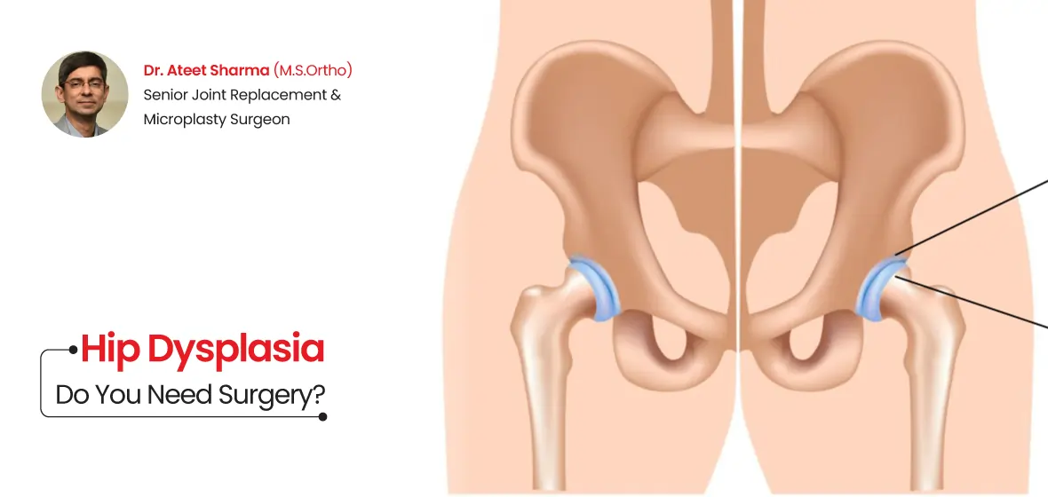 Hip Dysplasia - Do You Need Surgery